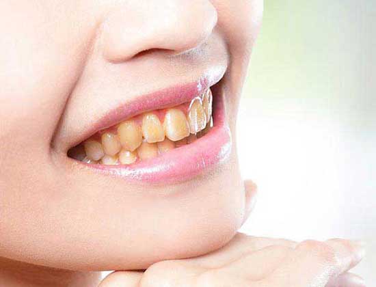 Rezultat tratament dentar la clinica Bident — Înainte