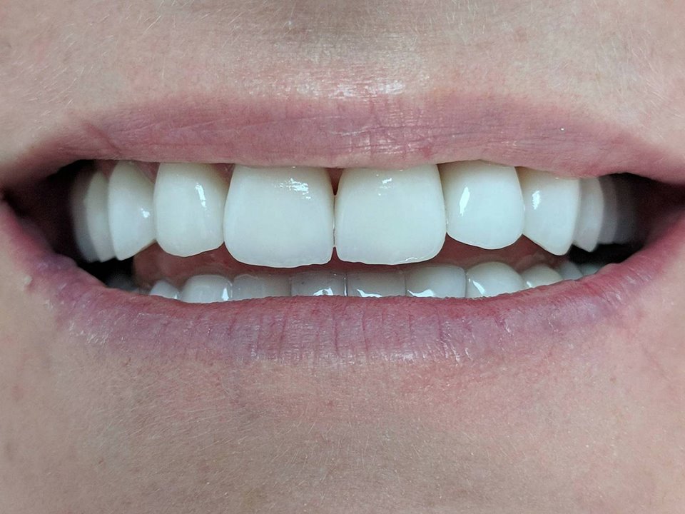 Fațete Dentare ( Veneers)