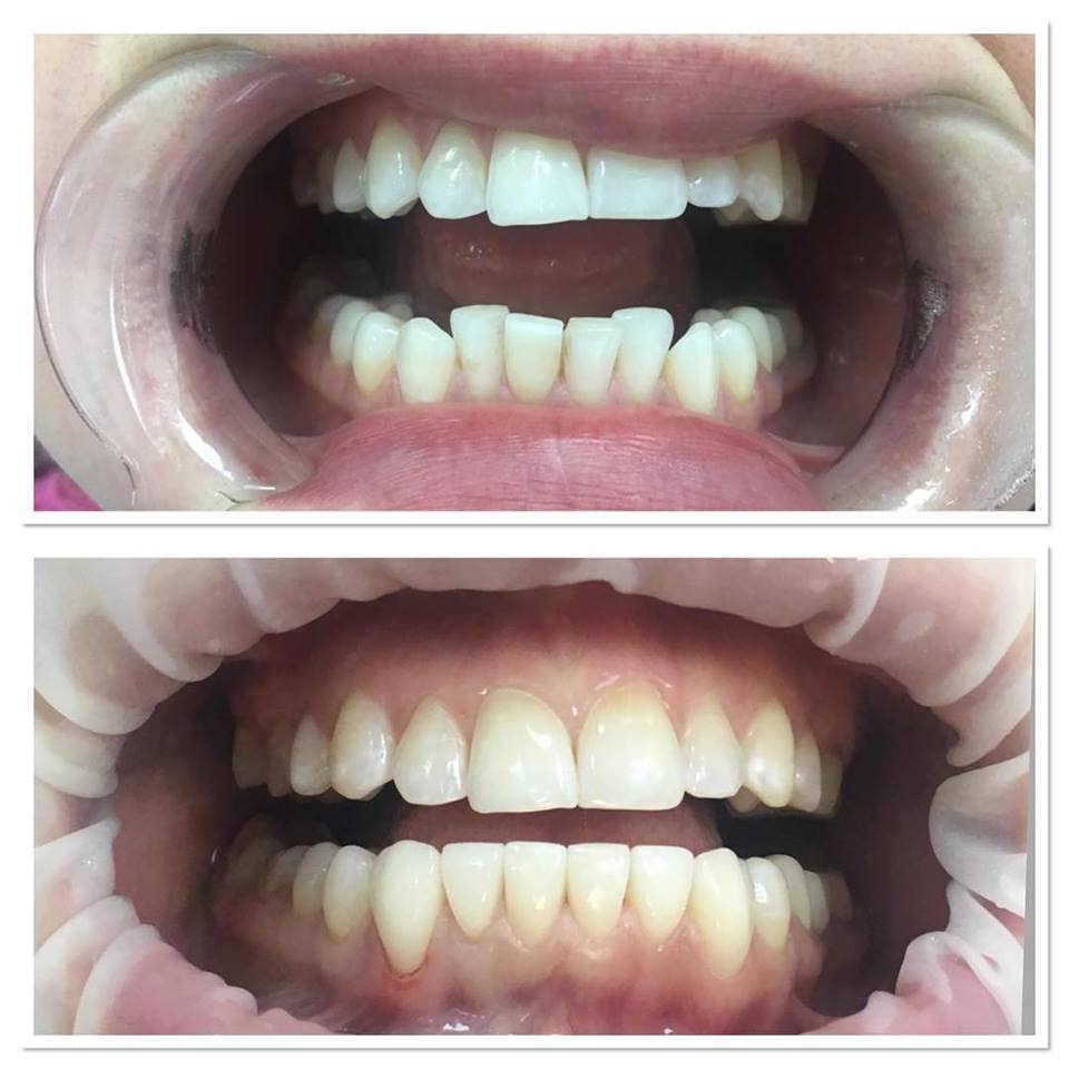 Fațete Dentare ( Veneers)