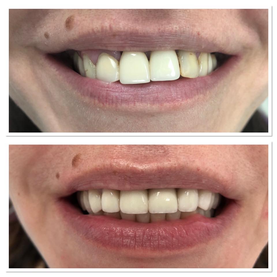 Fațete Dentare ( Veneers)