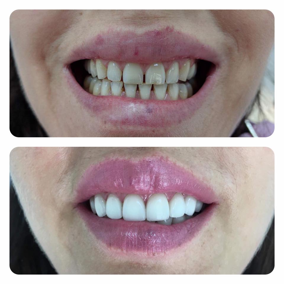 Fațete Dentare ( Veneers)
