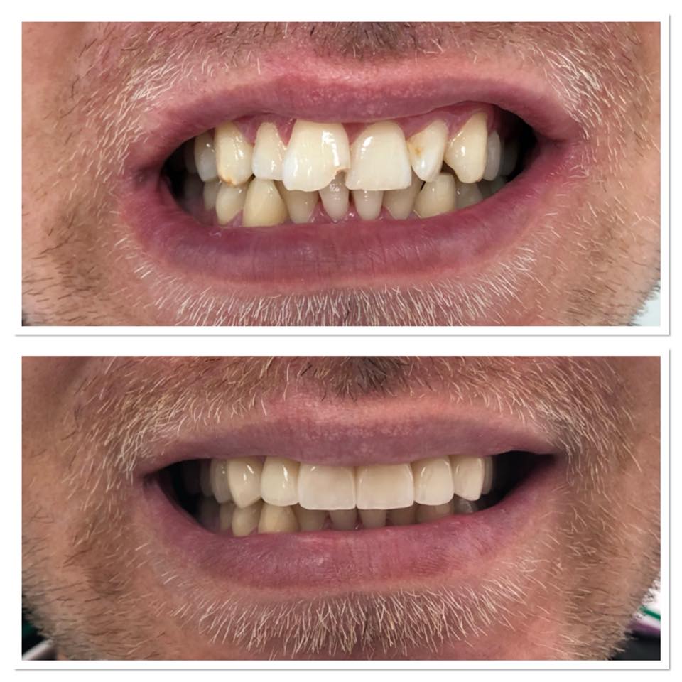 Fațete Dentare ( Veneers)