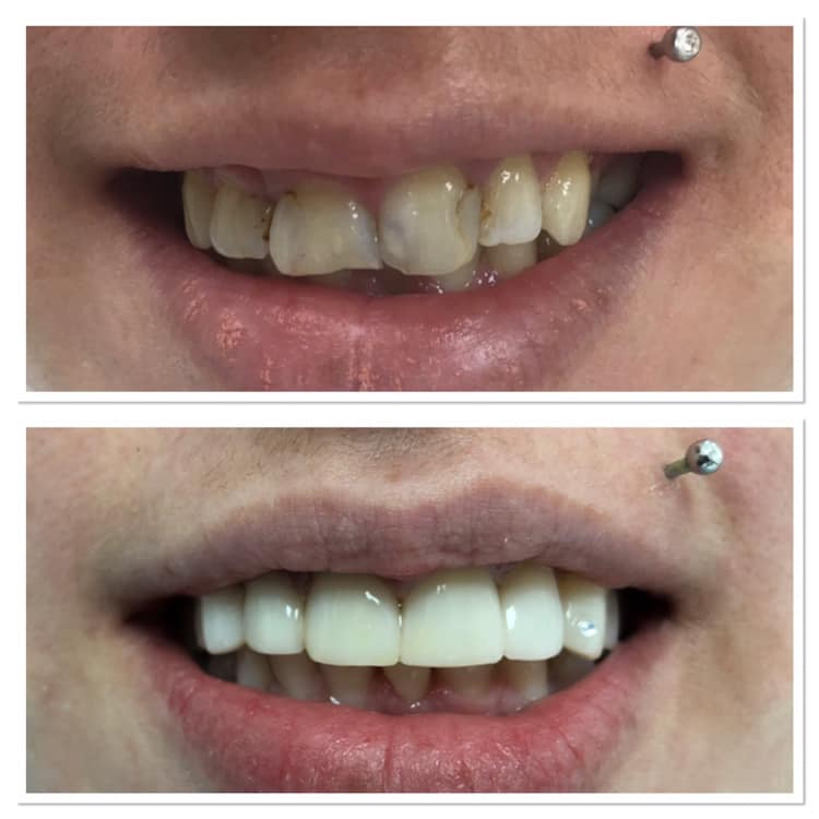 Fațete Dentare ( Veneers)