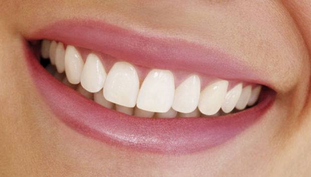 Fațete Dentare ( Veneers)