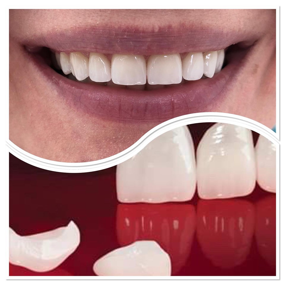 Fațete Dentare ( Veneers)