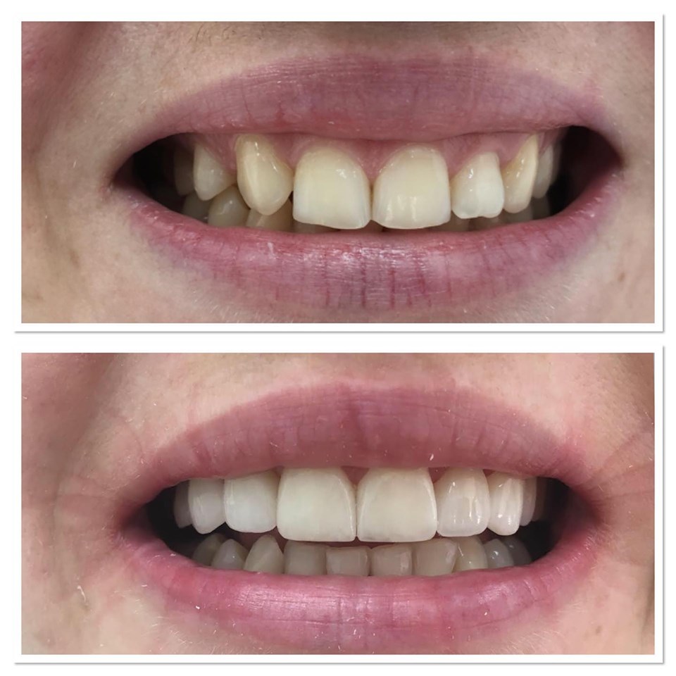 Fațete Dentare ( Veneers)