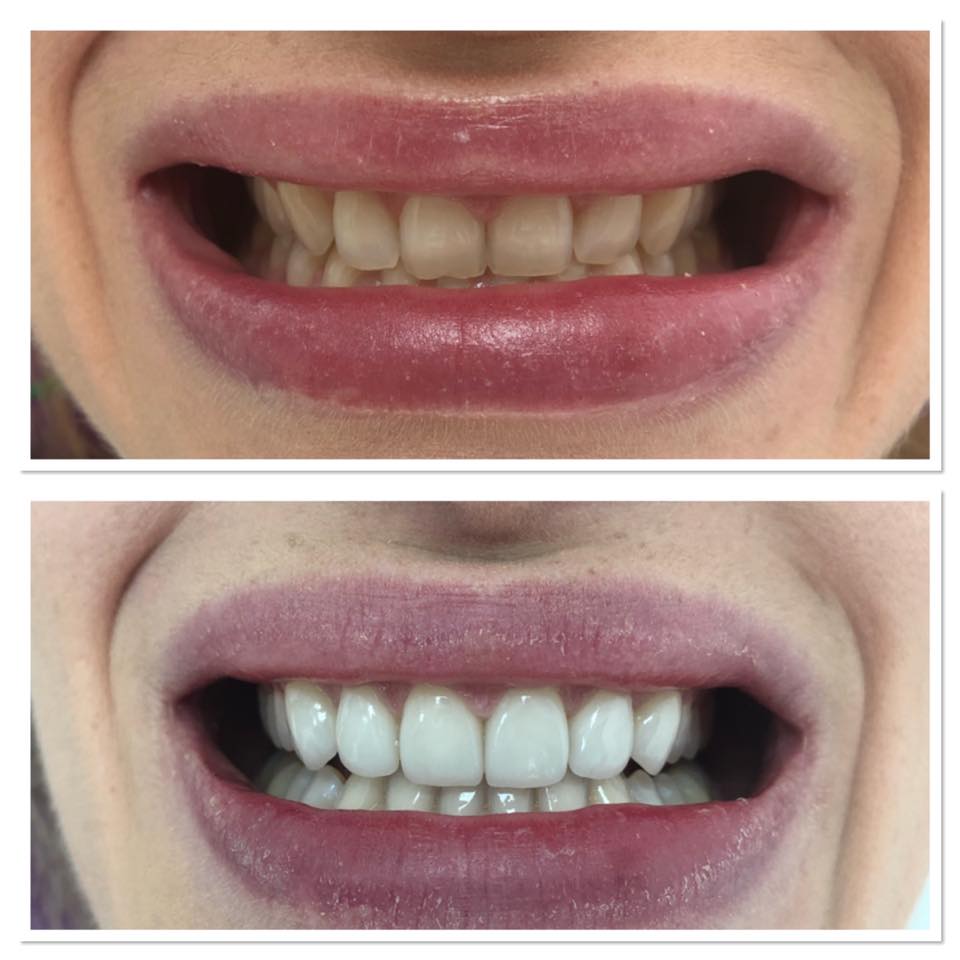 Bracketuri dentare