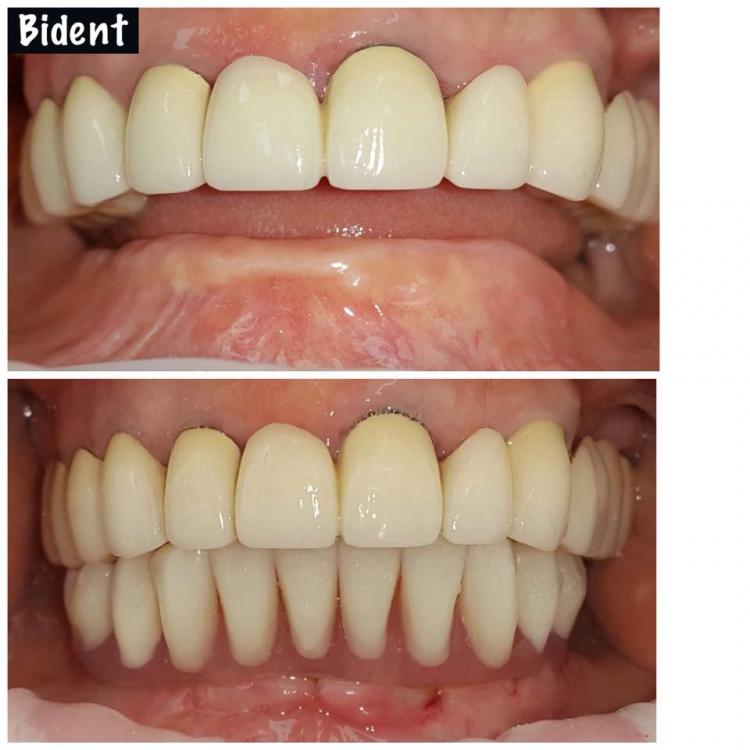 Implant dentar & chirurgie orală — 1