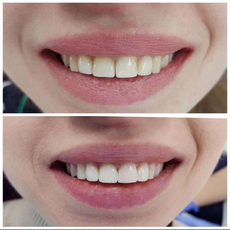 Reconstrucții estetice dentare — 1