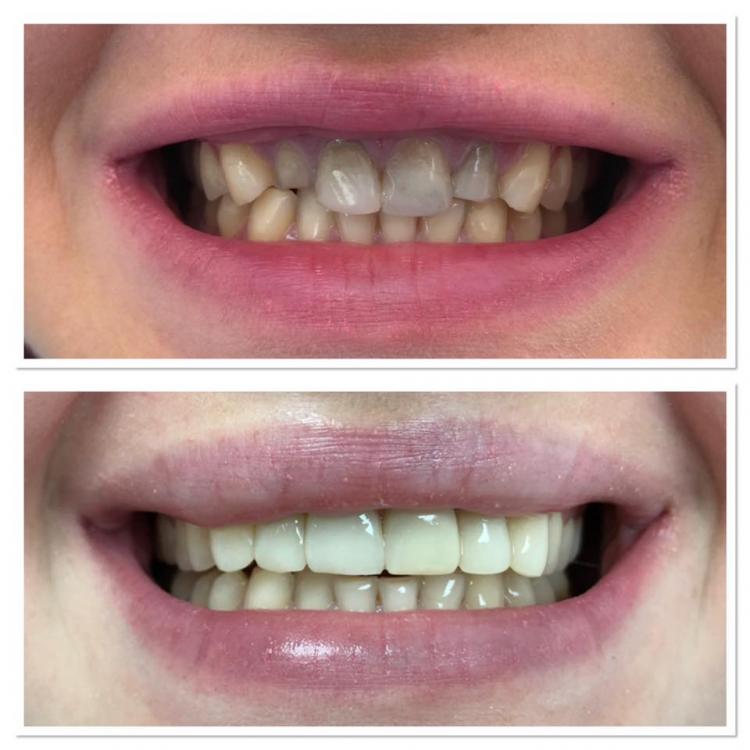 Reconstrucții estetice dentare — 2