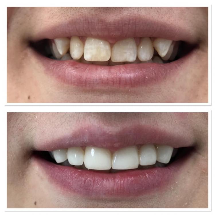 Reconstrucții estetice dentare — 3