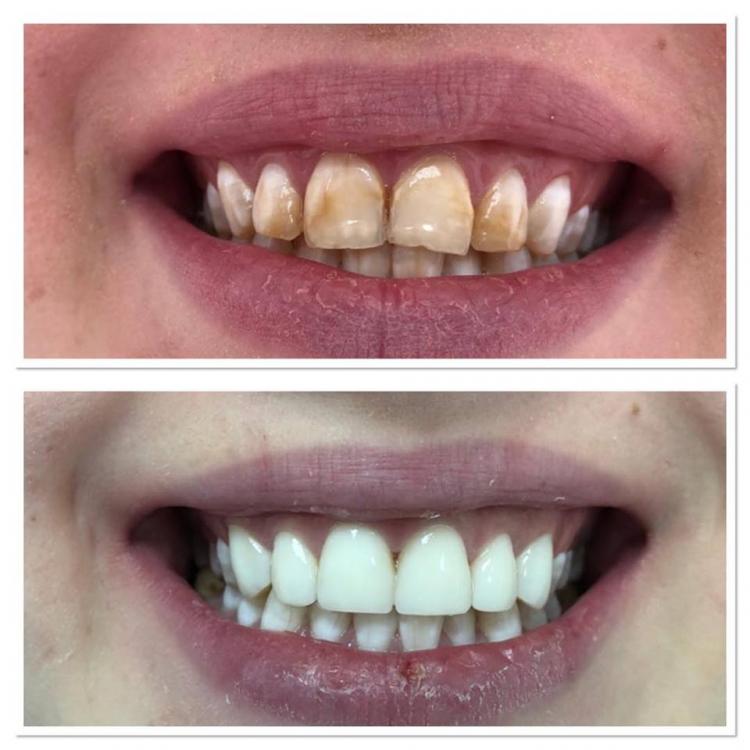 Reconstrucții estetice dentare — 4