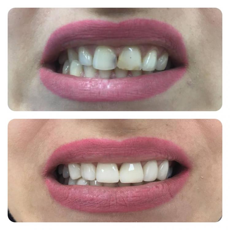 Reconstrucții estetice dentare — 5