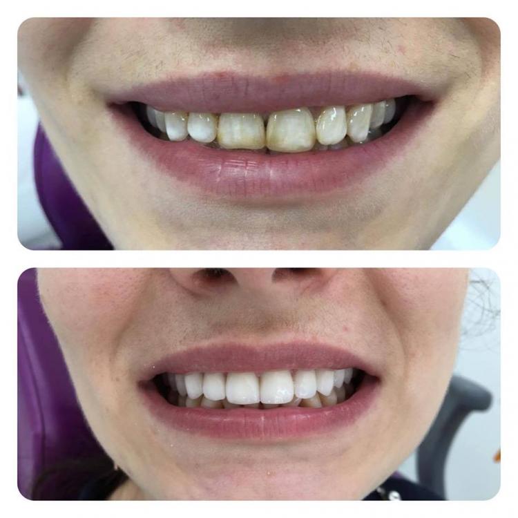 Fațete dentare / veneers — 2