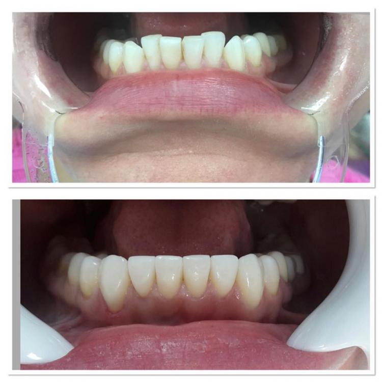 Fațete dentare / veneers — 3