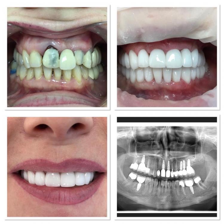 Implant dentar & chirurgie orală — 3