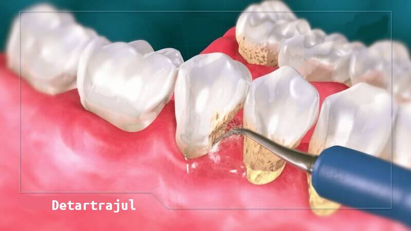 Detartraj cu ultrasunet & Air Flow